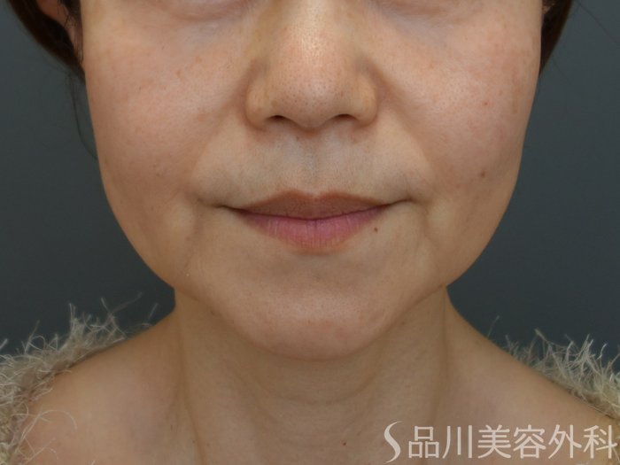 症例NO.75334のBEFORE写真