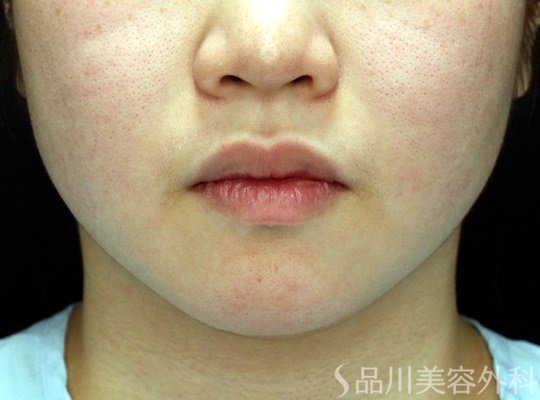 症例NO.70961のBEFORE写真