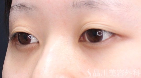 症例NO.70291のBEFORE写真
