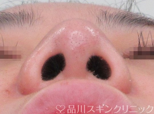 症例NO.69945のAFTER写真