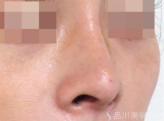 症例NO.27474のAFTER写真