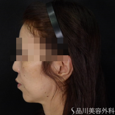 症例NO.73836のBEFORE写真