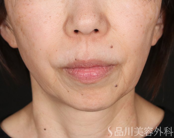 症例NO.73410のBEFORE写真