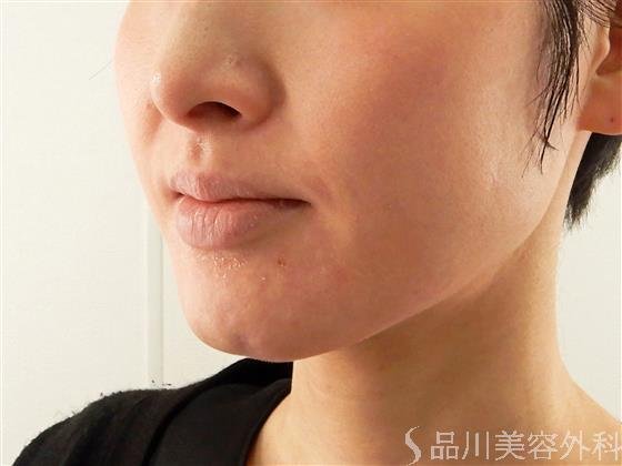 症例NO.57627のBEFORE写真