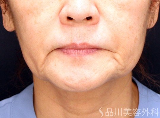 症例NO.70228のBEFORE写真