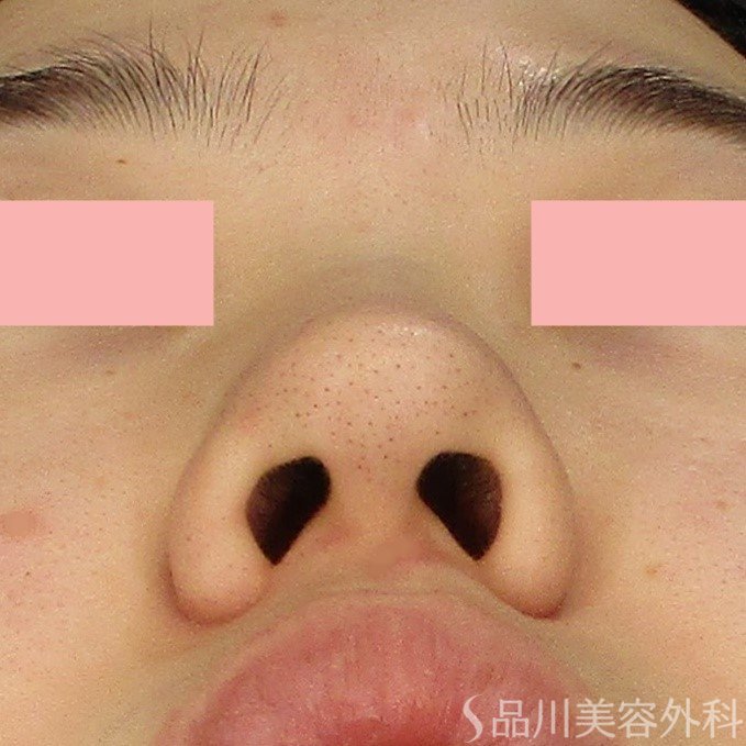 症例NO.71663のBEFORE写真