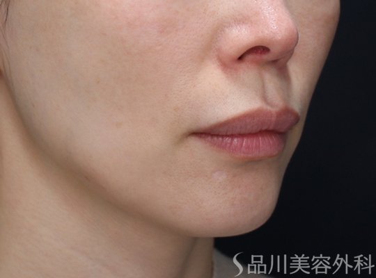 症例NO.73348のAFTER写真