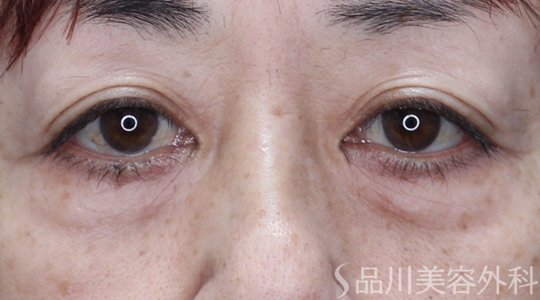 症例NO.71148のBEFORE写真