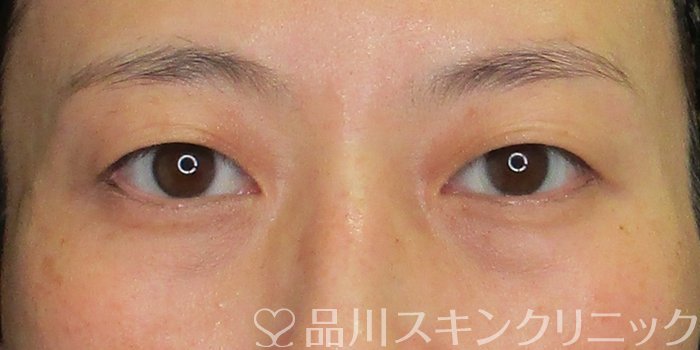 症例NO.70479のBEFORE写真
