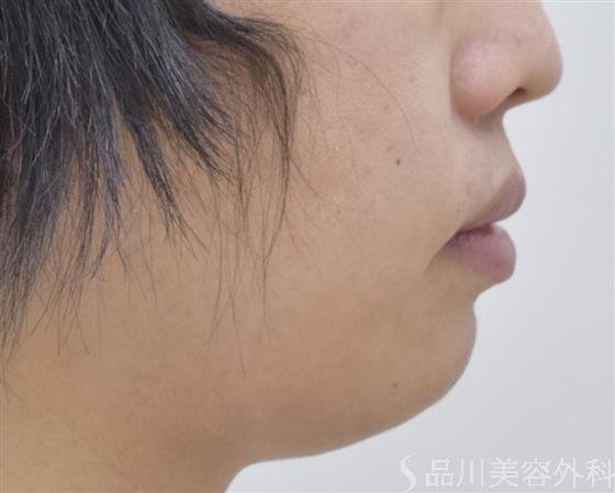 症例NO.47916のBEFORE写真
