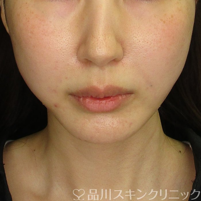 症例NO.70552のAFTER写真