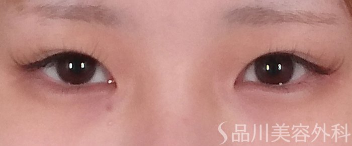 症例NO.70404のBEFORE写真