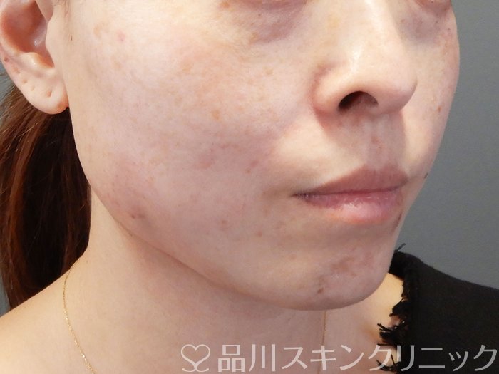 症例NO.72769のAFTER写真