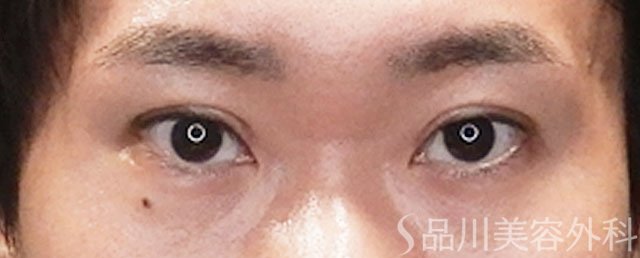 症例NO.72269のAFTER写真