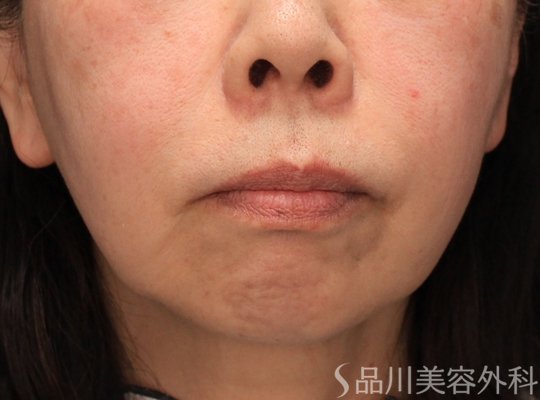 症例NO.72432のBEFORE写真