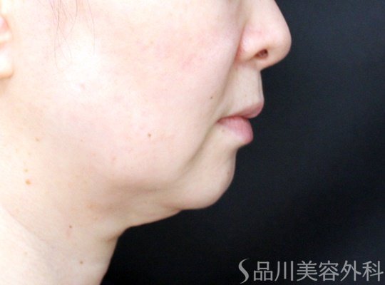 症例NO.70344のBEFORE写真