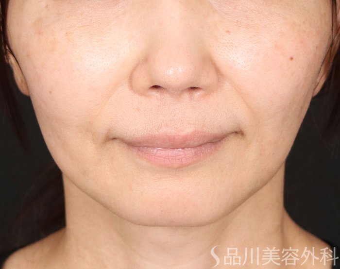 症例NO.71636のBEFORE写真
