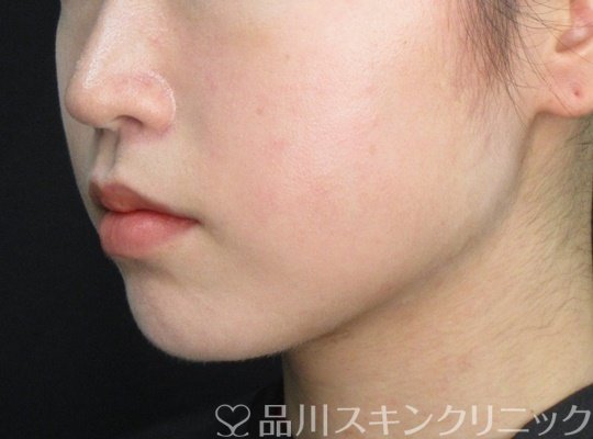 症例NO.71549のAFTER写真