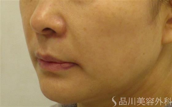 症例NO.58630のBEFORE写真