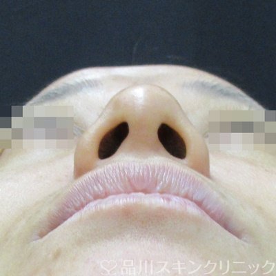 症例NO.71707のBEFORE写真