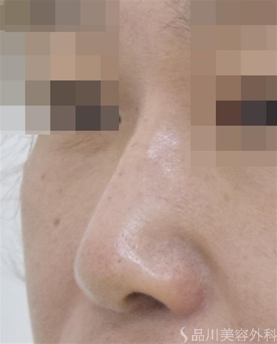 症例NO.50010のAFTER写真