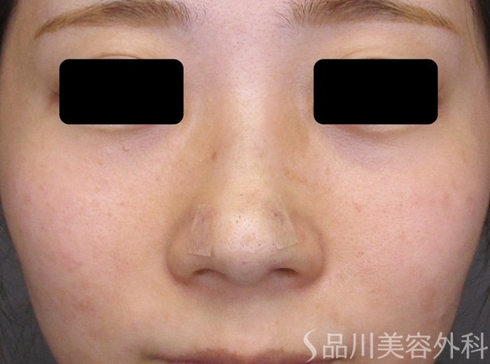 症例NO.74892のAFTER写真