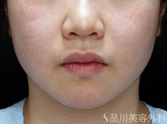 症例NO.69971のBEFORE写真