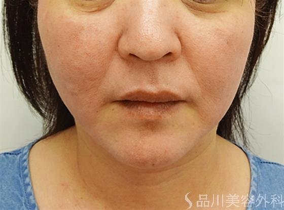 症例NO.36277のAFTER写真