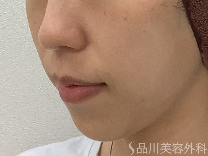 症例NO.67892のBEFORE写真