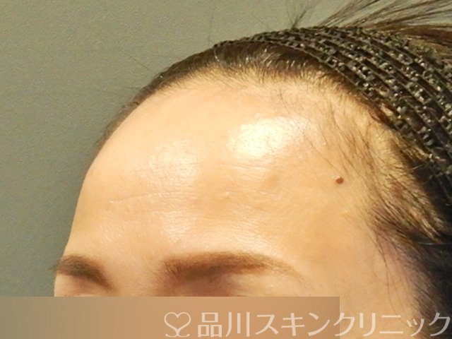 症例NO.66431のBEFORE写真