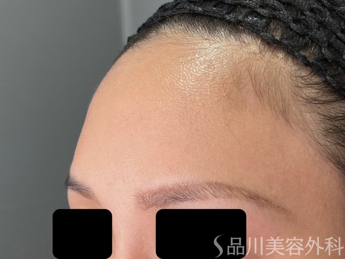 症例NO.70656のBEFORE写真