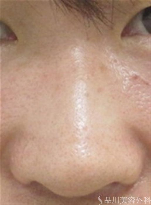 症例NO.16528のBEFORE写真