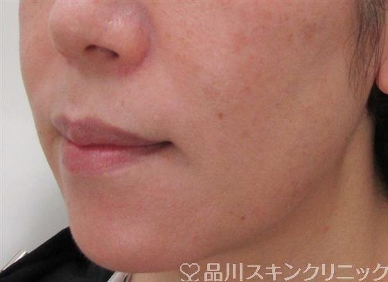 症例NO.31411のAFTER写真