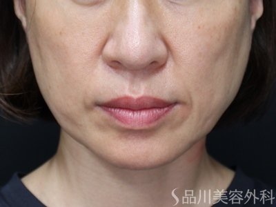 症例NO.75247のBEFORE写真