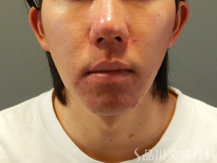 症例NO.65444のBEFORE写真