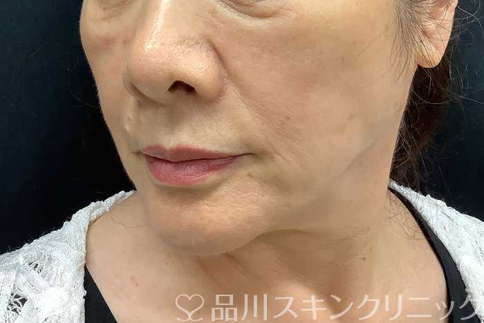 症例NO.69839のBEFORE写真