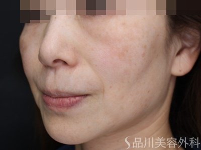 症例NO.70993のBEFORE写真