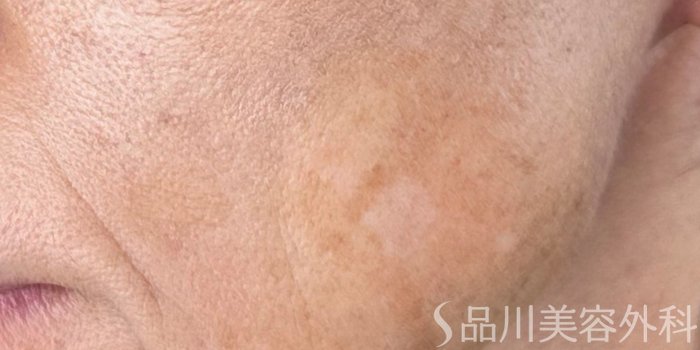 症例NO.72725のAFTER写真