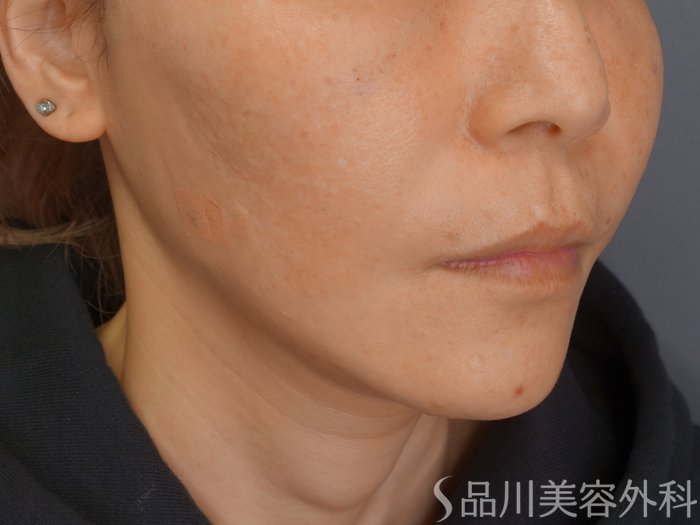 症例NO.67767のAFTER写真