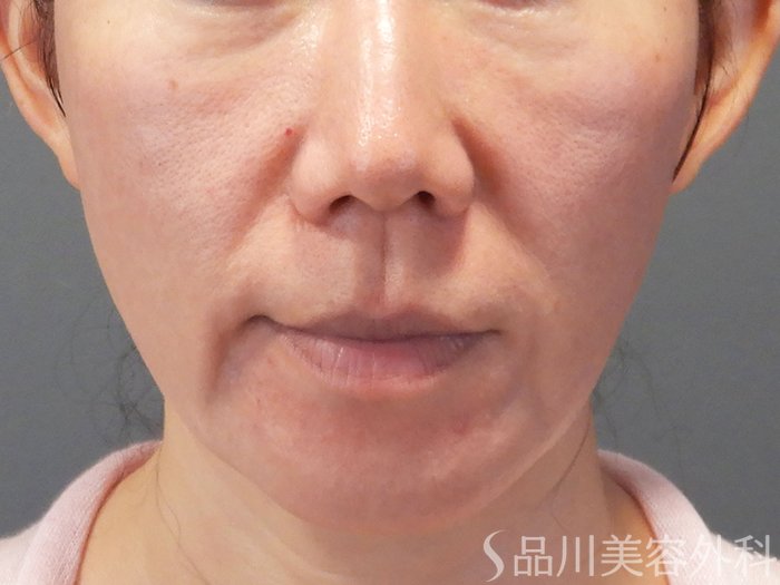 症例NO.71691のBEFORE写真