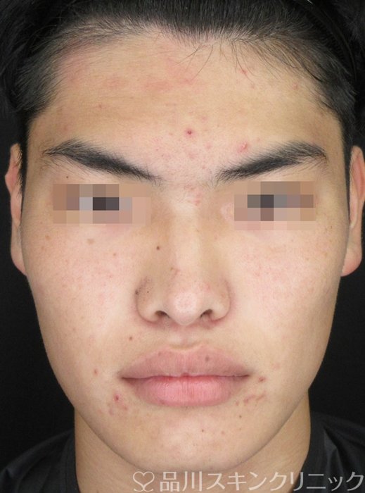 症例NO.69349のBEFORE写真