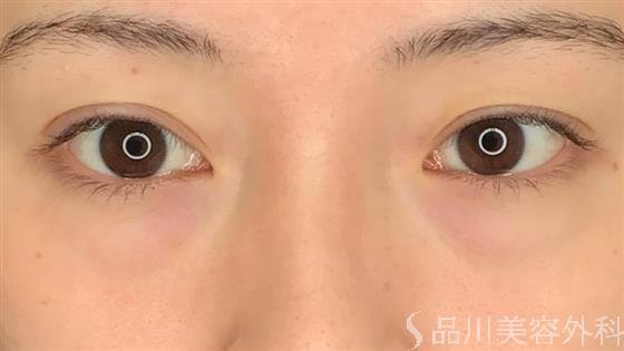 症例NO.61362のBEFORE写真