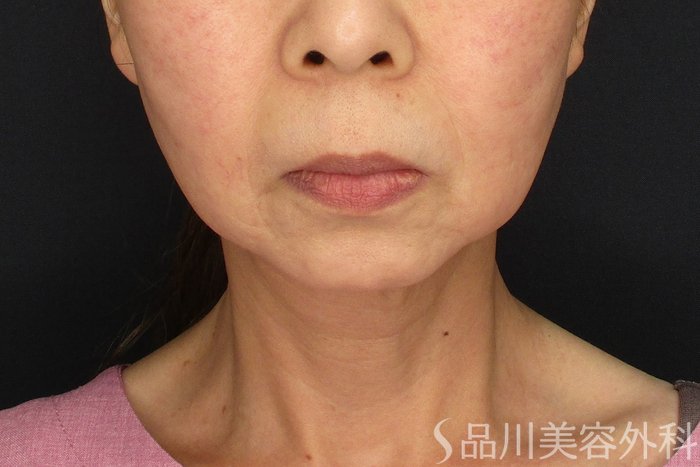 症例NO.72176のBEFORE写真