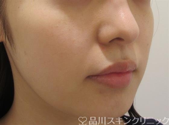 症例NO.33126のBEFORE写真