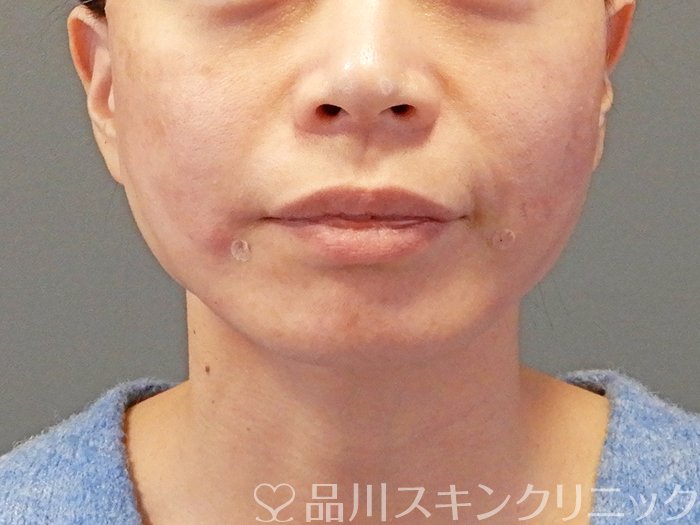症例NO.63591のAFTER写真