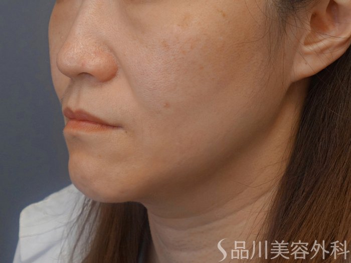 症例NO.74238のBEFORE写真