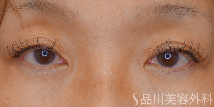 症例NO.70646のBEFORE写真