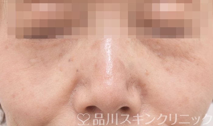 症例NO.70014のAFTER写真