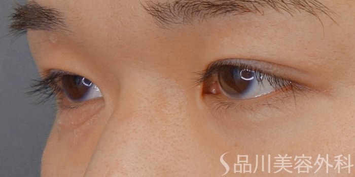 症例NO.72581のAFTER写真