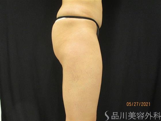 症例NO.52778のAFTER写真